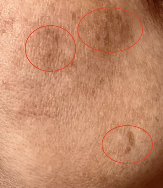 黑斑是如何形成的呢