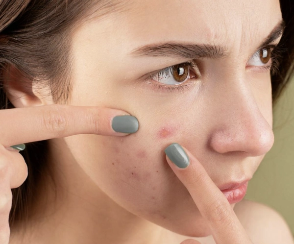 痘痘不擠會怎樣