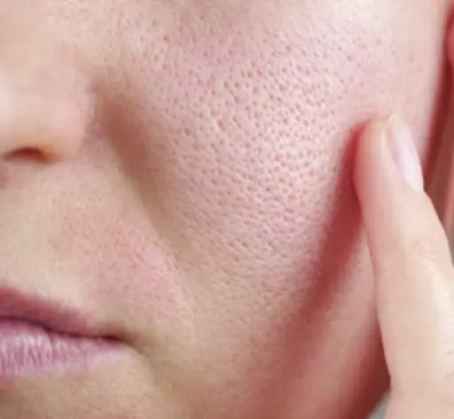 如隔改善毛孔粗大